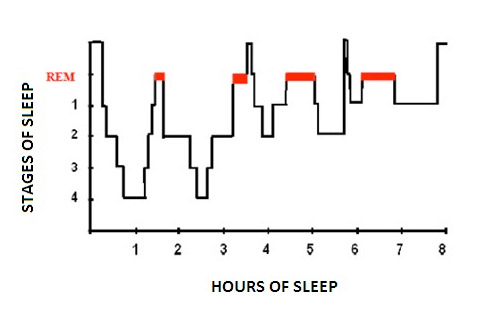 1: Hypnogram of sleep cycle in a healthy young adult. Normal sleep involves cycling through NREM and REM sleep, beginning with stage 1 through to stage 4, followed by REM sleep. (Adapted from Lin VW, Cardenas DD, Cutter NC, et al. Spinal Cord Medicine: Principles and Practice. New York: Demos Medical Publishing; 2003.)